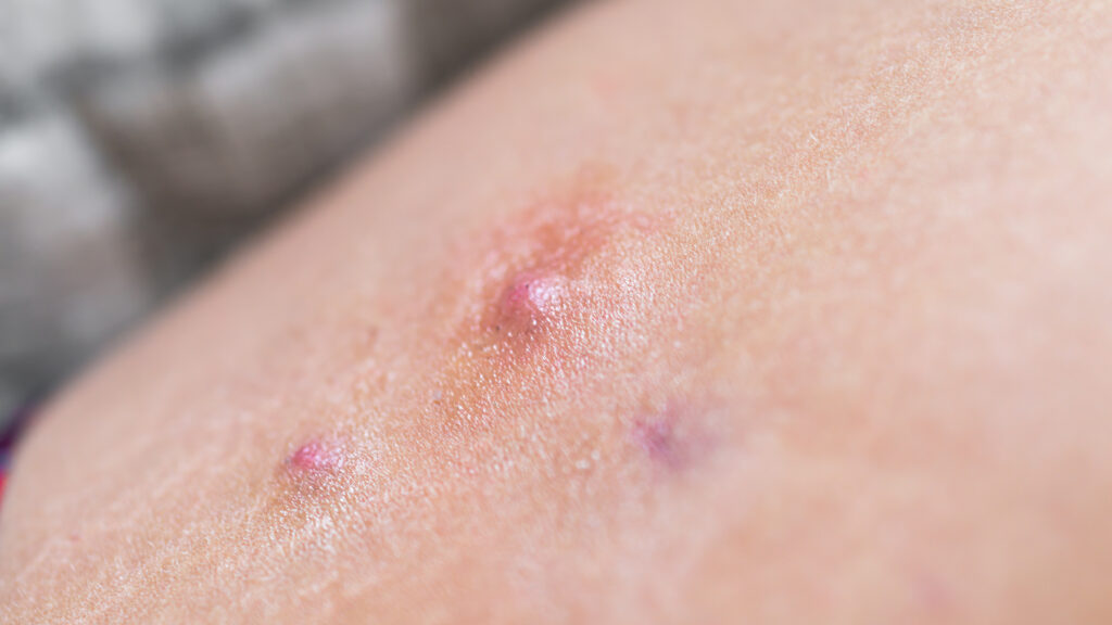 AbbVie skin disorder drug succeeds in late-stage trial, but misses market expectations