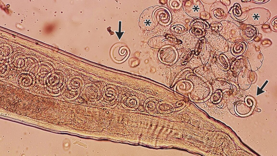 Worms mate in man’s eyes, get plucked out right before larvae burst out